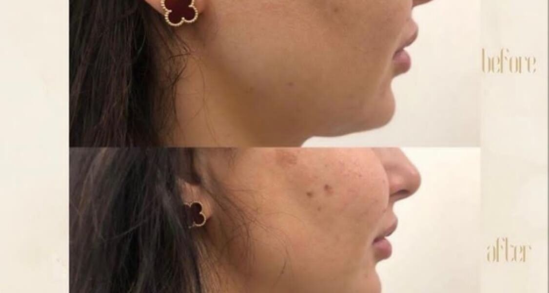 مركز Dermanda Clinic يقدم HIFU