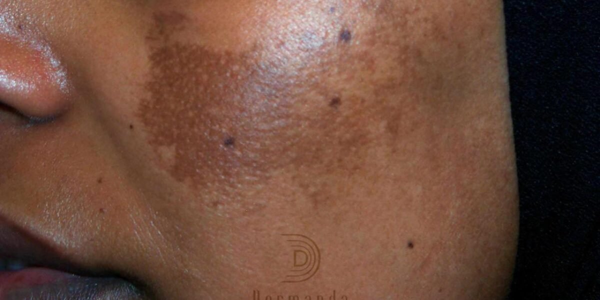 صورة مميزة: Dermanda Clinic إسم رائد في علاج الكلف بمختلف أنواعه
